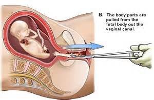 bortion